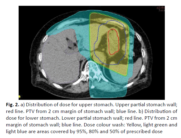 oncology-radiotherapy-partial-stomach
