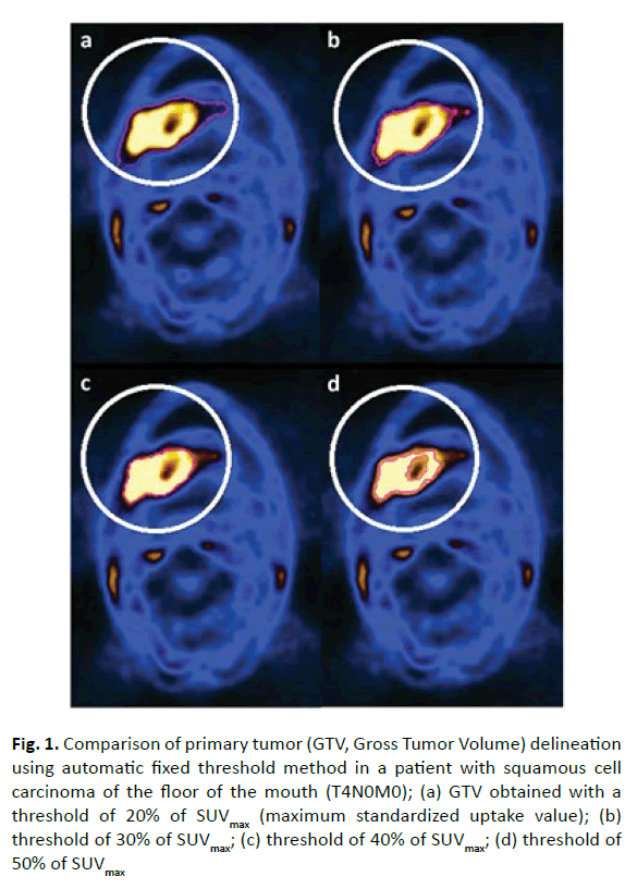 oncology-radiotherapy-primary-tumor