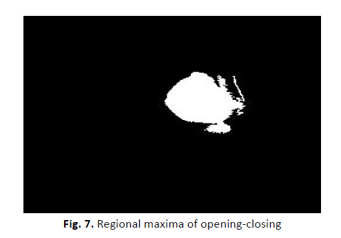 oncology-radiotherapy-regional-maxima