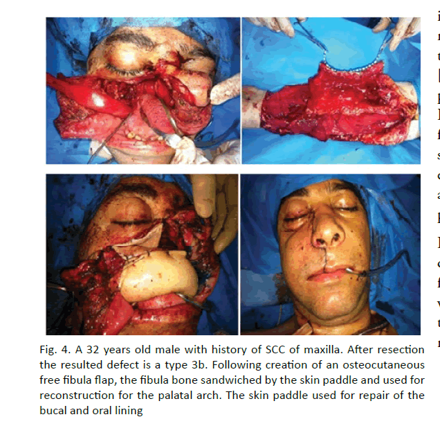 oncology-radiotherapy-resulted-defect