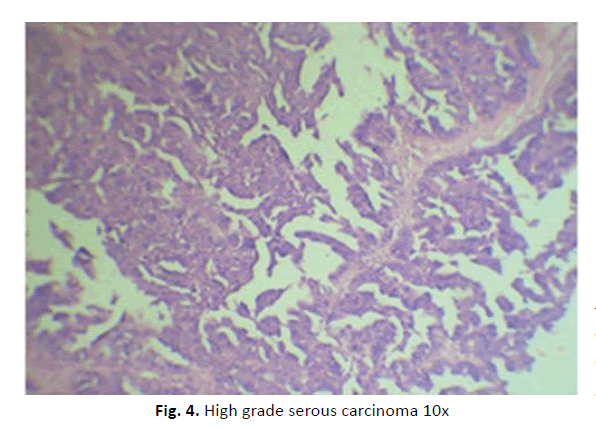 oncology-radiotherapy-serous-carcinoma