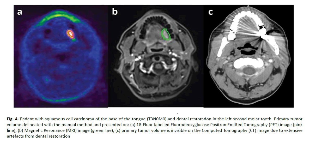 oncology-radiotherapy-squamous-cell