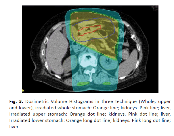 oncology-radiotherapy-three-technique