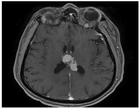 oncologyradiotherapy-MRI