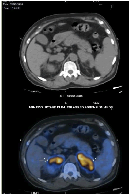 oncologyradiotherapy-adrenal