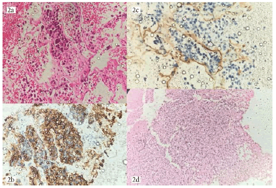 oncologyradiotherapy-lymphoid