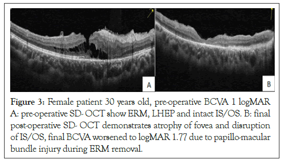 ophthalmology-atrophy