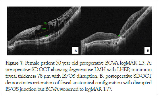 ophthalmology-degenerative