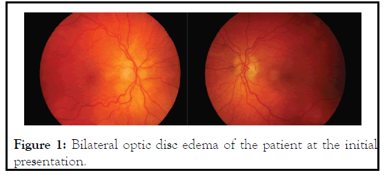 ophthalmology-edema