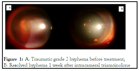 ophthalmology-hyphema