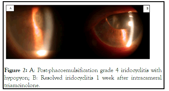 ophthalmology-iridocyclitis