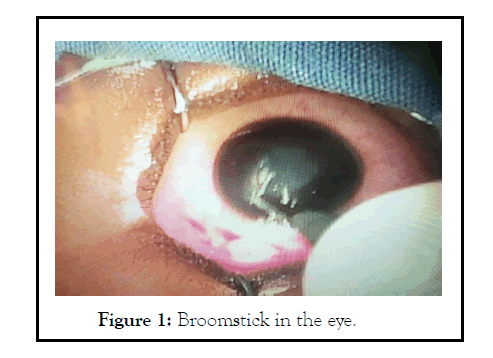 ophthalmology-meta-broomstick