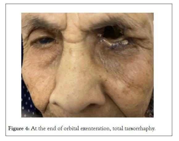 ophthalmology-meta-tarsorrhaphy