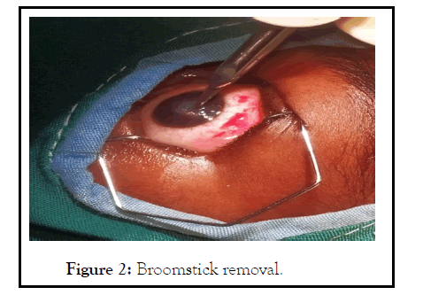 ophthalmology-removal