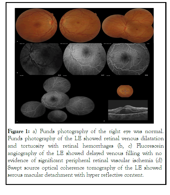 ophthalmology-venous