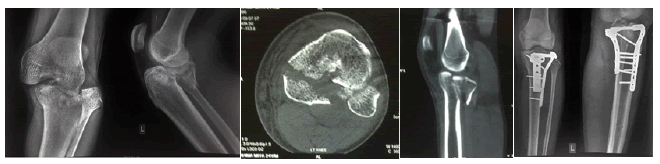 orthopedic-muscular-fracture