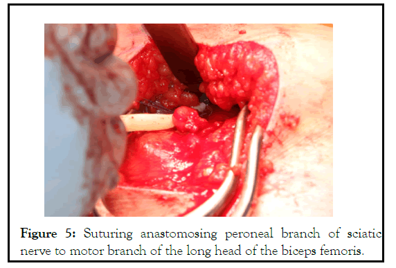 physical-medicine-peroneal