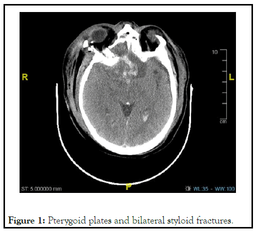 physical-medicine-styloid