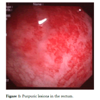 Purpuric Lesions in the Rectum: Clinical Image