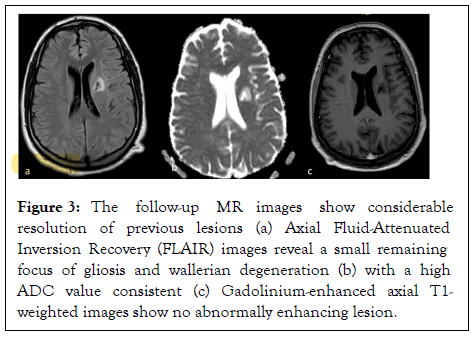 rheumatology-gliosis