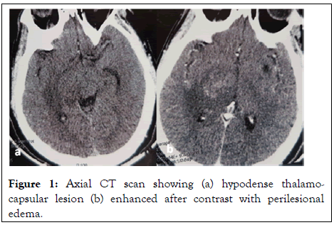 rheumatology-perilesional-edema