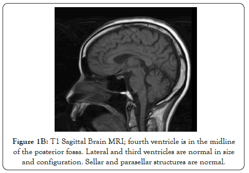 rheumatology-ventricle