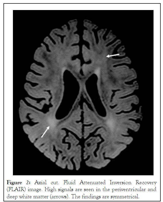 toxicology-periventricular