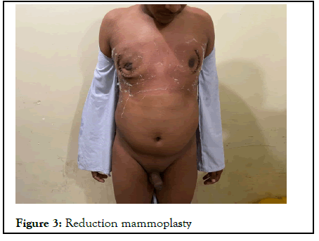 Andrology-mammoplasty