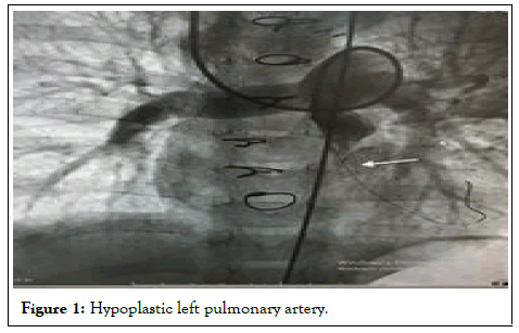 pulmonary