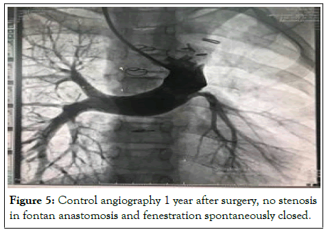 stenosis