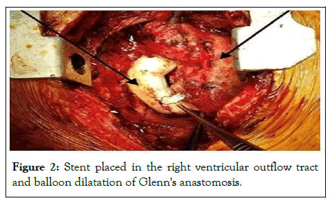 ventricular