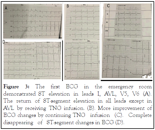 ECG