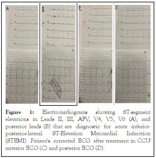 Electrocardiograms