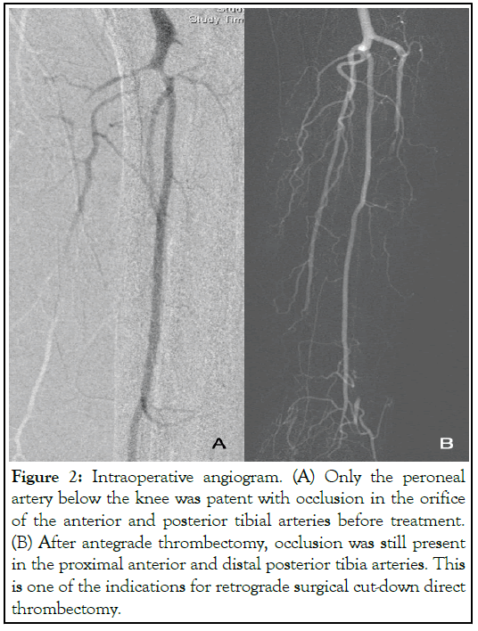 Intraoperative