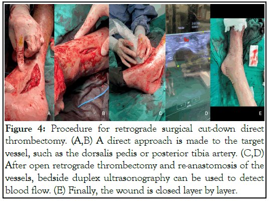 thrombectomy