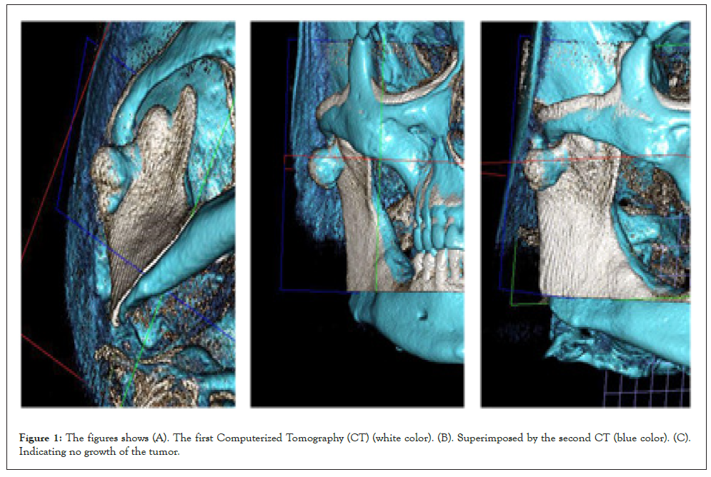 Tomography