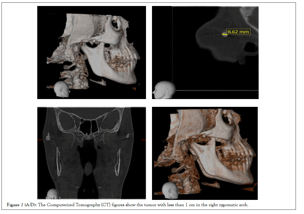 zygomatic