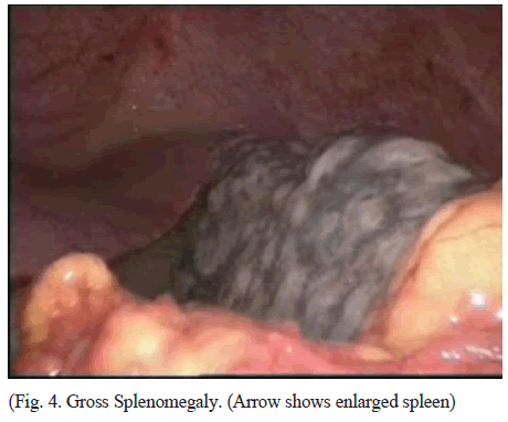 Cancer-Science-Splenomegaly