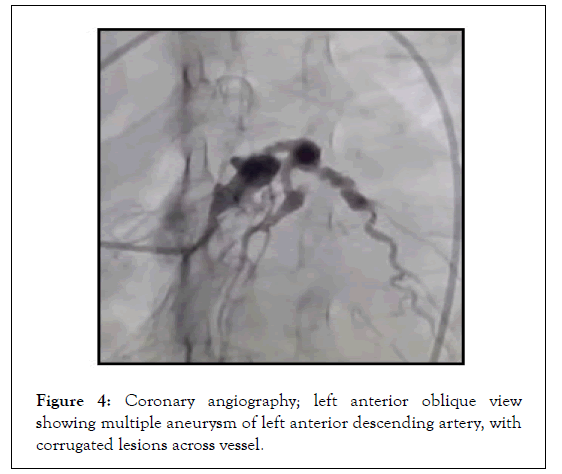 Cardiology-aneurysm