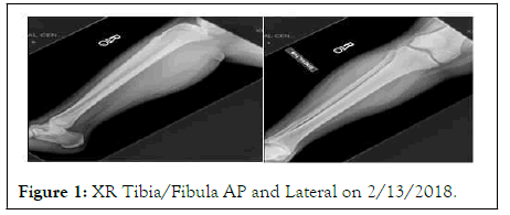 fibula