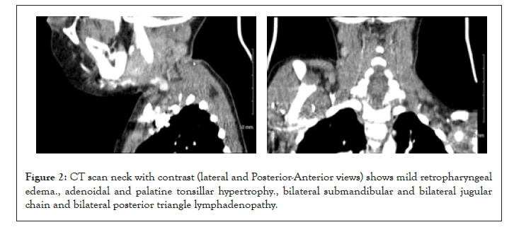 Clinical-Pediatrics-retropharyngeal