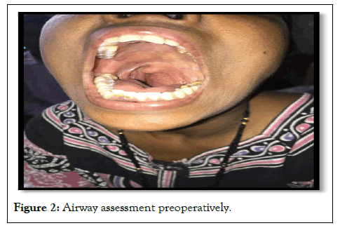 airway