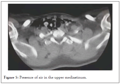 mediastinum