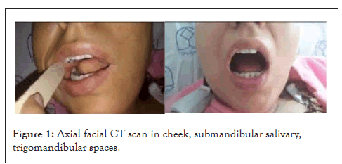 salivary