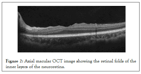 Neuroretina