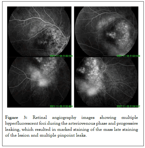 angiography