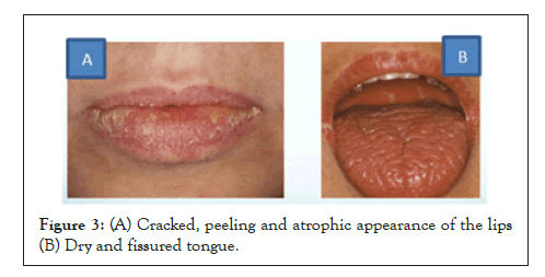 Experimental-Ophthalmology-atrophic