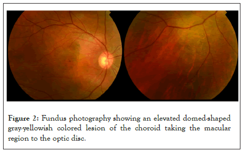 macular