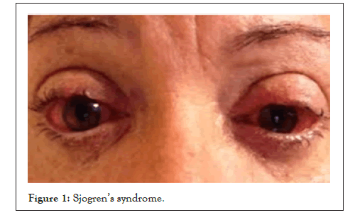 Experimental-Ophthalmology-syndrome