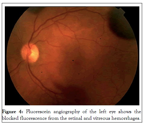 JCEO-angiography